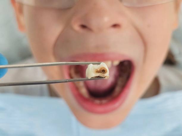 Best Emergency Broken Tooth Repair in Watsessing, NJ